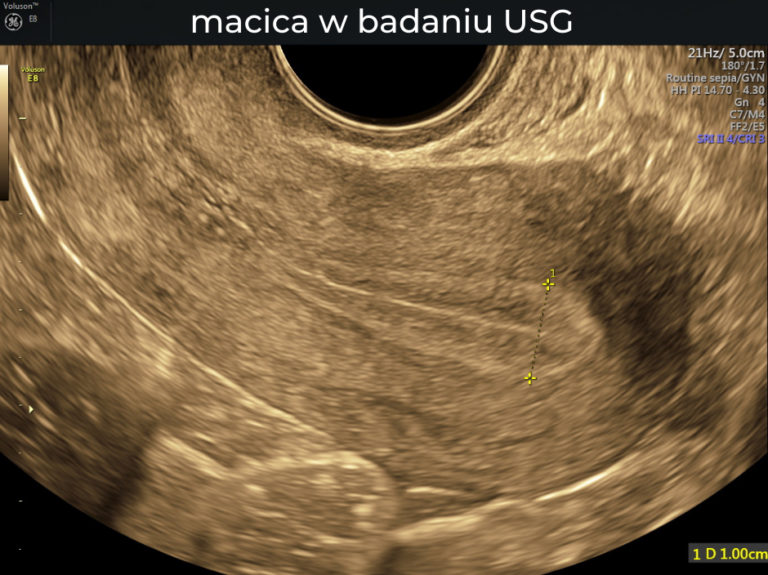 Usg Ginekologiczne Sonofem Centrum Medyczne Warszawasonofem Centrum Medyczne Warszawa 0376