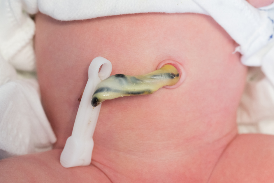 Aktualne zasady pielęgnacji pępka i kikuta pępowinowego u noworodka