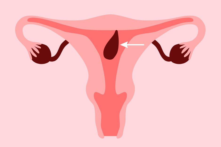 Czym jest polip endometrialny?