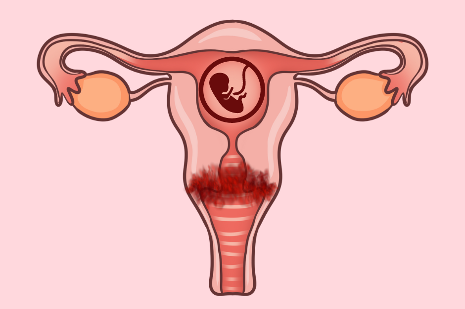 Rak szyjki macicy w ciąży