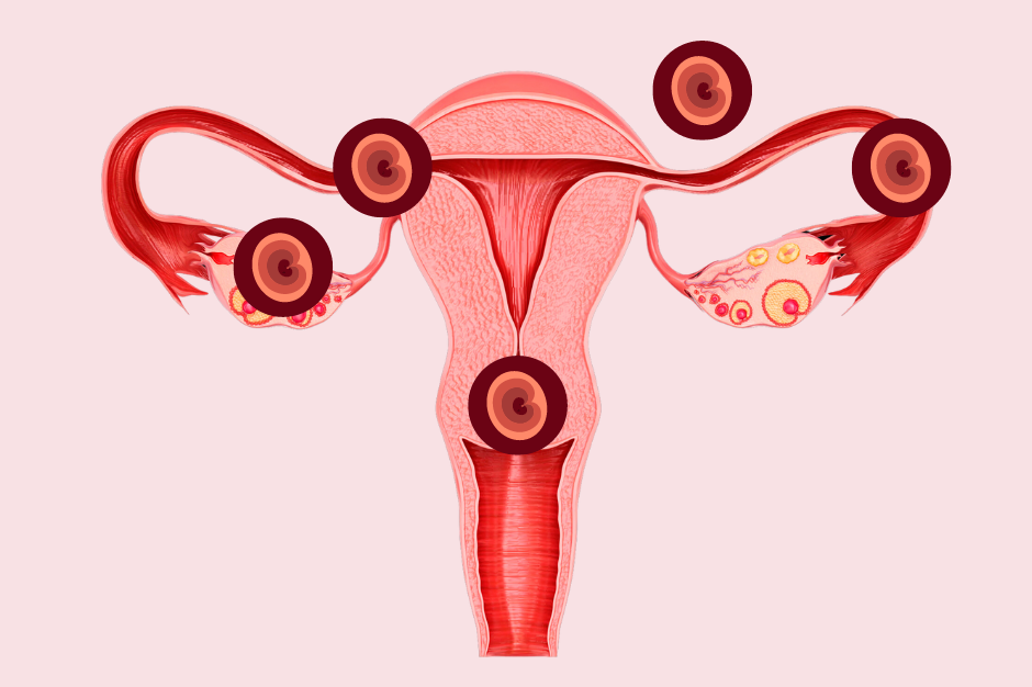 Ciąża pozamaciczna – częsty problem w ginekologii