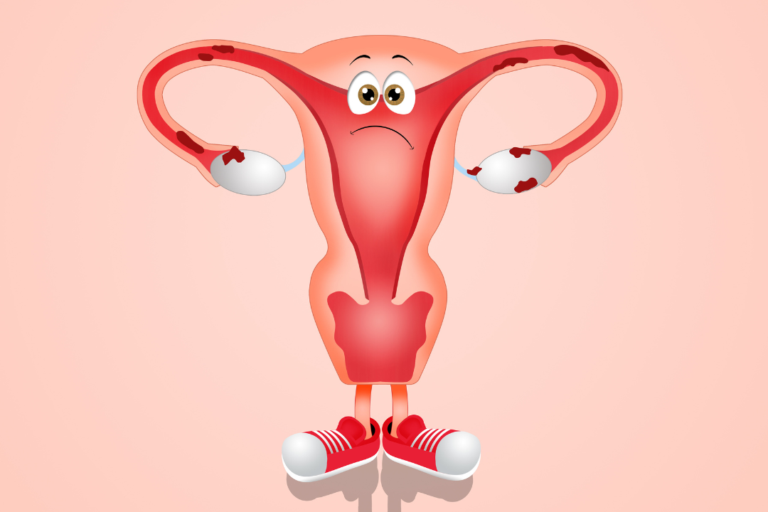 Mit o przyczynie endometriozy