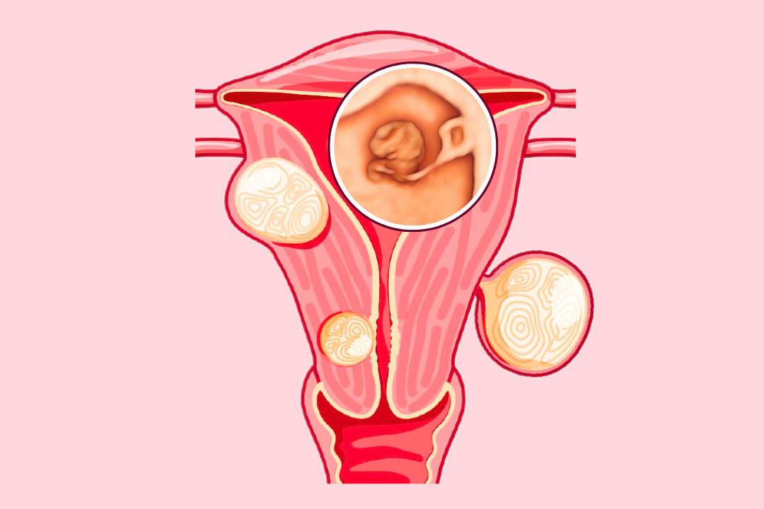 Jak mięśniaki macicy wpływają na ciążę?