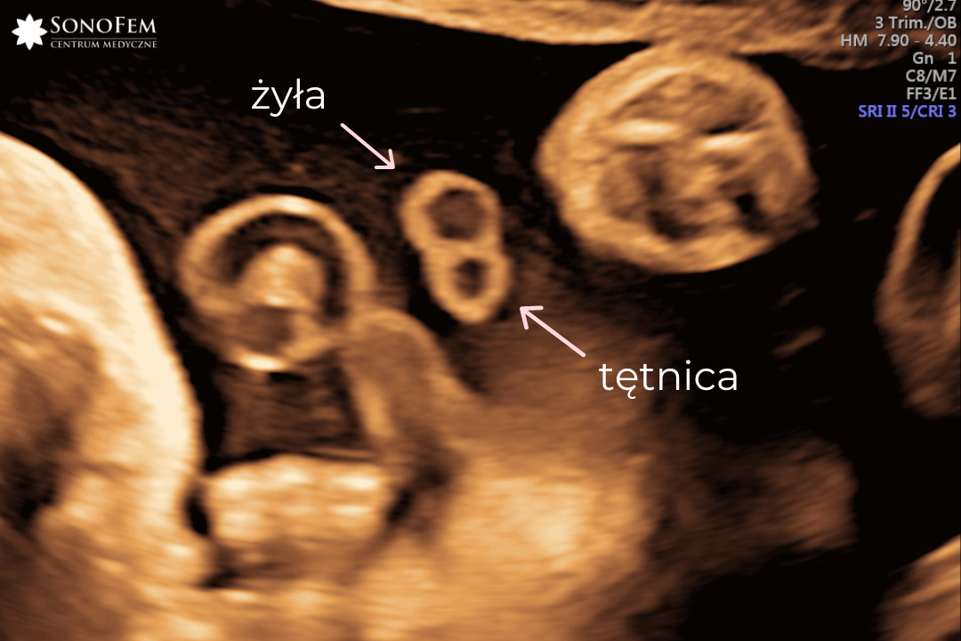 Dwunaczyniowa pępowina – jakie ma znaczenie?