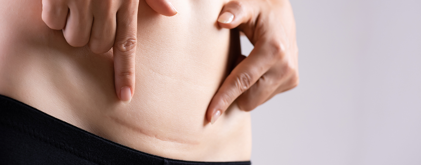 Lasrowe_usuwanie_blizn po cesarskim cieciu_i_nacieciu_krocza